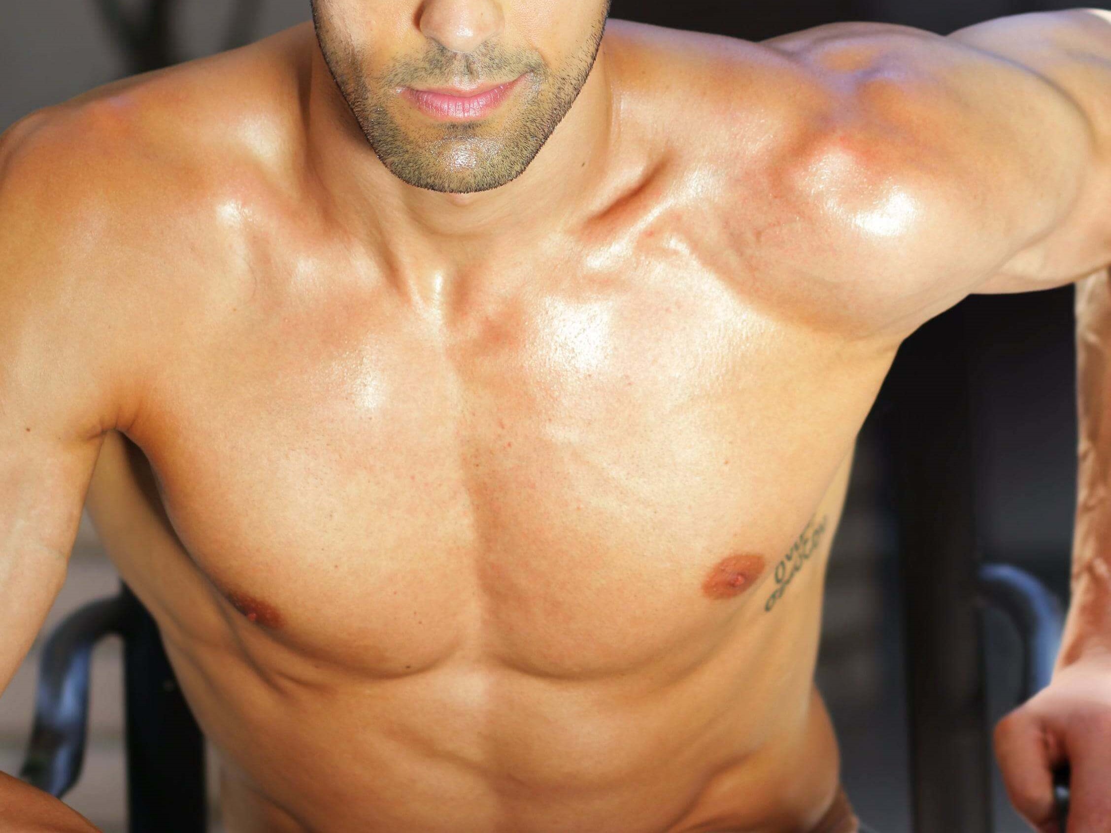 Gynecomastia